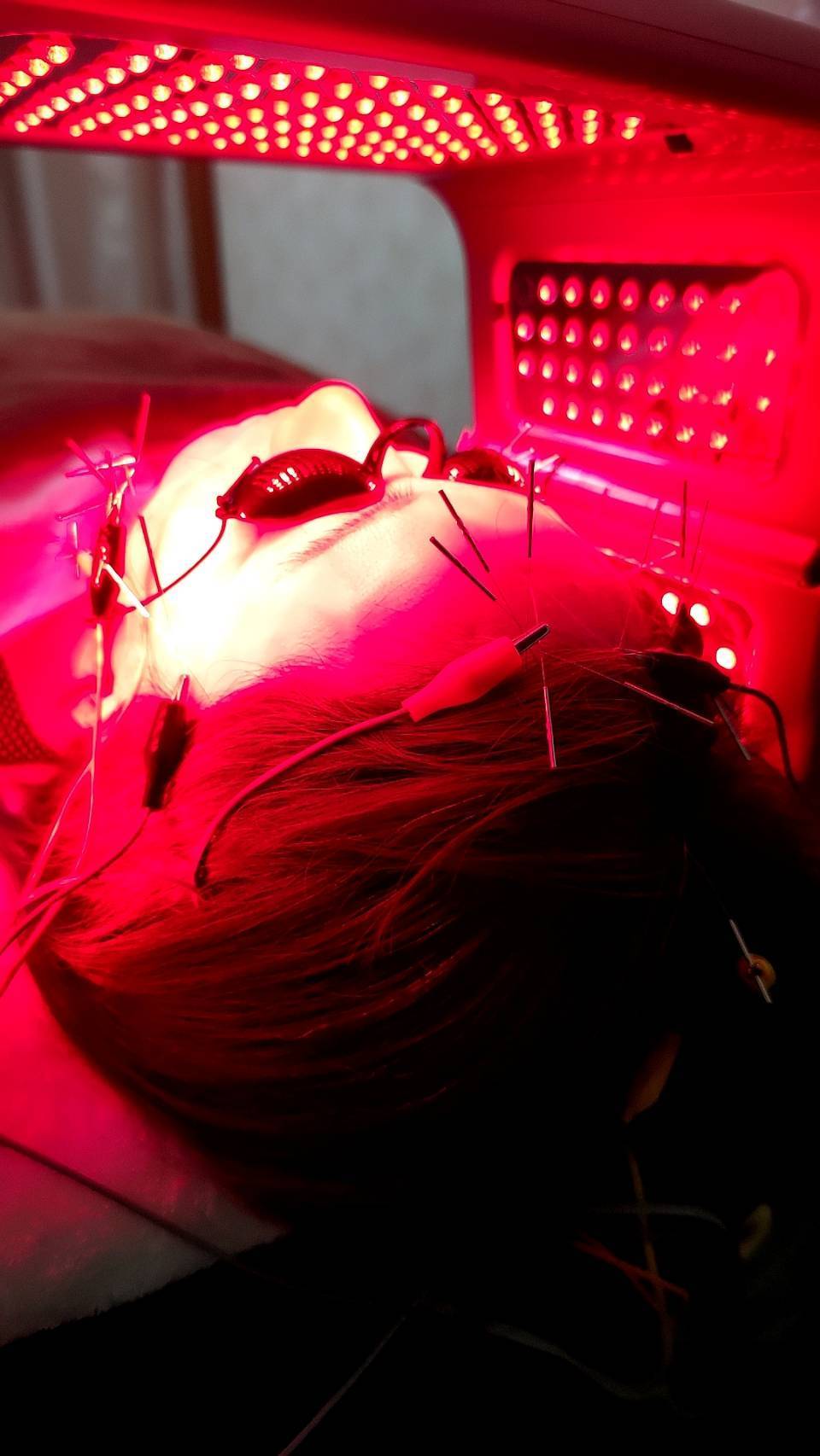 頭皮に鍼を施している様子